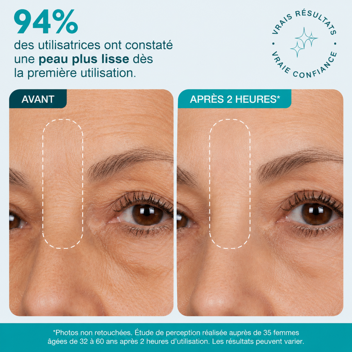Patch Skinjection — Lisse les pattes d’oie, les rides du sourire & du front