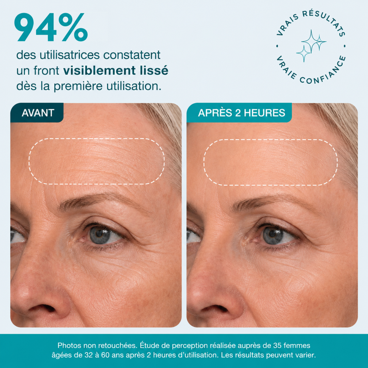 Patch Skinjection —  Lisse les pattes d’oie, les rides du sourire & du front
